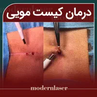 درمان زگیل،لیپوم،میخچه،کیست مویی،خال توسط پزشک|خدمات آرایشگری و زیبایی|اصفهان, سعادت‌آباد|دیوار