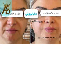 جوانسازی قوی  لیفت صورت ،روشن کننده هایفوتراپی|خدمات آرایشگری و زیبایی|یاسوج, |دیوار