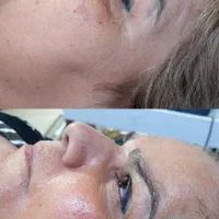 پاکسازی فیشال مزونیدلینگ اسکالپ کربوکسی پلکسر|خدمات آرایشگری و زیبایی|مشهد, رسالت|دیوار