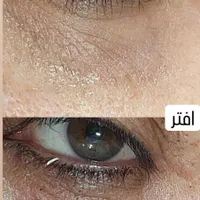 پلکسر مزو میکرونیلدینگ  رفع خال جوانسازی فیشیال|خدمات آرایشگری و زیبایی|مشهد, طلاب|دیوار