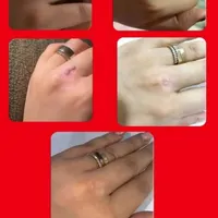 برطرف کردن زگیل و تبخال تناسلی بصورت ریشه ای|آرایشی، بهداشتی، درمانی|مشهد, دانشگاه فردوسی|دیوار