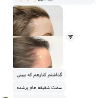 قطع ریزش مو و رویش مجدد مو|آرایشی، بهداشتی، درمانی|تهران, حسین‌آباد|دیوار