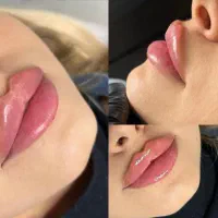 آموزش ژل و بوتاکس/لیفت نخ/لابیاپلاستی/ساکشن غبغب|خدمات آموزشی|تهران, فرمانیه|دیوار