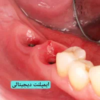 دندانپزشکی ایمپلنت کامپوزیت ارتودنسی لمینت روکش|خدمات آرایشگری و زیبایی|تبریز, |دیوار