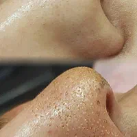 پلکسر مزو میکرونیلدینگ  رفع خال جوانسازی فیشیال|خدمات آرایشگری و زیبایی|مشهد, طلاب|دیوار
