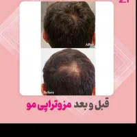 درمان تخصصی ریزش و قطع ریزش مو در کلینیک تخصصی|خدمات آرایشگری و زیبایی|برازجان, |دیوار