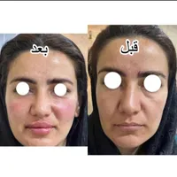 خدمات تخصصی ژل و بوتاکس|خدمات آرایشگری و زیبایی|شاهین‌شهر, فردوسی|دیوار