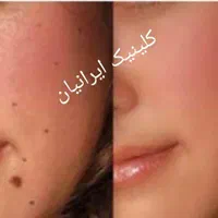 برداشتن خال،زگیل،جوانسازی،پرسینگ،چال گونه