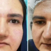 لیزر مو جشنواره. ژل بوتاکس حذف تتو و لک جوانسازی|خدمات آرایشگری و زیبایی|ساری, |دیوار