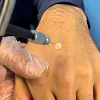 درمان زگیل تناسلی/لیزر/کرایو فریز/hpv/توسط پزشک|خدمات آرایشگری و زیبایی|اهواز, کیانپارس |دیوار