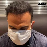 کاشت موی طبیعی|خدمات آرایشگری و زیبایی|اهواز, زیتون کارمندی|دیوار