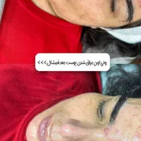 فیشال ،مزونیدلینگ،اسیدتراپی،کربوکسی،پلاژن