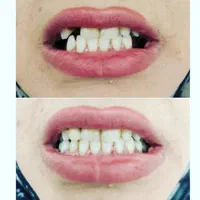 دندانسازی میعاد دندان مصنوعی|خدمات آرایشگری و زیبایی|کرمان, |دیوار