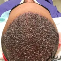 کاشت مو تراکم بالا (بدون تراشیدن سر)