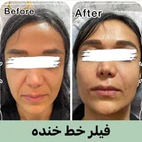 جشنواره هایفوتراپی،ژل، بوتاکس،لیزر در کلینیک پزشکی|خدمات آرایشگری و زیبایی|رشت, معلم|دیوار