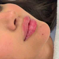 ژل بوتاکس فیلر مزو نخ کانتورینگ‌ درکلینیک زیبایی|خدمات آرایشگری و زیبایی|تبریز, |دیوار