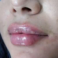 جشنواره ژل بوتاکس آنزیم فیلر پرسینگ فشیال پاکسازی|خدمات آرایشگری و زیبایی|مشهد, صیاد شیرازی|دیوار