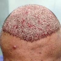 کاشت مو،کاشت ابرو و ریش تخصصی|خدمات آرایشگری و زیبایی|شیراز, قصرالدشت|دیوار