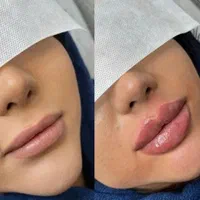 اف ژل لب وآف بوتاکس درمطب پزشک