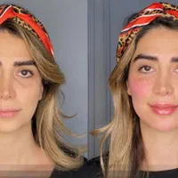 اصلاح فرم صورت.جوانسازی به روش یانگ فیس توسط متخصص|خدمات آرایشگری و زیبایی|مشهد, سناباد|دیوار