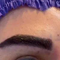کاشت مو، ابرو و ریش با تراکم و طراحی فوق العاده