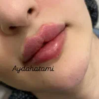 اف تزریق ژل و بوتاکس توسط کادر درمان در کلینیک|خدمات آرایشگری و زیبایی|اهواز, پادادشهر|دیوار