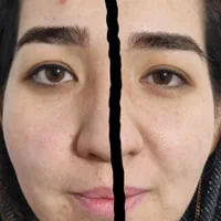 جشنواره هایفو وآراف تراپی همراه فیشیال رایگا|خدمات آرایشگری و زیبایی|رشت, رودباری|دیوار