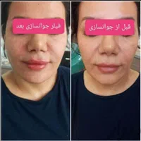 سابسیژن فیلر اندولیفت ژل بادی هایفو مزو بوتاکس|خدمات آرایشگری و زیبایی|کرج, مهرویلا جنوبی|دیوار