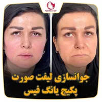 یانگ فیس صورت Noa بینی ابرو غبغب سینه باسن شکم پلک|خدمات آرایشگری و زیبایی|مشهد, هفت تیر (حافظ)|دیوار
