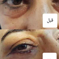 عمل زیبائی پلک پائین شامل پف ، چروک و...|خدمات آرایشگری و زیبایی|اصفهان, خلجا|دیوار