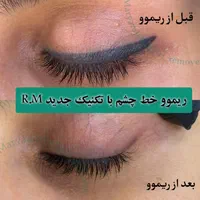تخفیف ریموو تتو ابرو، خط چشم و لب در مرکز پوست غرب|خدمات آرایشگری و زیبایی|تهران, باغ فیض|دیوار