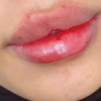 فیلر و بوتاکس با متد جدید|خدمات آرایشگری و زیبایی|رشت, گلسار|دیوار