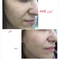 لیزر co2 فراکشنال و هایفوی پزشکی نه رومیزی