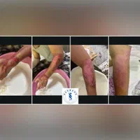 کلینیک تخصصی درمان انواع زخم(بستر و دیابت) فردوس|خدمات آرایشگری و زیبایی|اصفهان, محله سفلی|دیوار