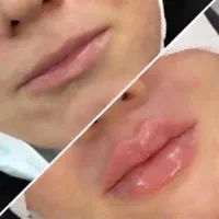تزریق ژل لب بوتاکس هایفولیزرفیلرلیفت صورت سفیدسازی|خدمات آرایشگری و زیبایی|تهران, صادقیه|دیوار