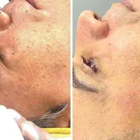 (پی آر پی بدون درد) رشد مجدد مو ،  جوانسازی صورت|خدمات آرایشگری و زیبایی|اهواز, زیتون کارمندی|دیوار