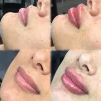 تزریق بوتاکس و فیلر