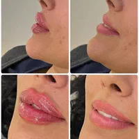 فیلر ژل بوتاکس نخ لیفت و جوانساز زاویه هایفو|خدمات آرایشگری و زیبایی|فردیس, فردیس|دیوار