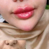 آموزش وتزریق ژل و بوتاکس و فیلر بادی وکامپوزیت|خدمات آرایشگری و زیبایی|اهواز, پردیس|دیوار