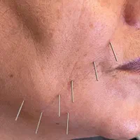 امبدینگ بادکش حجامت طب سوزنی فصد خون زگیل تناسلی|خدمات آرایشگری و زیبایی|اصفهان, باغ زرشک|دیوار