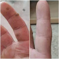 حذف خال ،میخچه ،زگیل فقط بامحلول گیاهی|خدمات آرایشگری و زیبایی|خمینیشهر, |دیوار