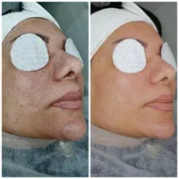 خدمات تخصصی پاکسازی فیشال صورت و بدن با دستگاه|خدمات آرایشگری و زیبایی|شاهین‌شهر, عطار|دیوار
