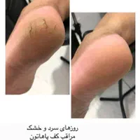 پدیکور تخصوصی درمان ترک کف پا|خدمات آرایشگری و زیبایی|مشهد, امام خمینی|دیوار