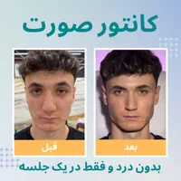 زاویه سازی صورت/فیلر و نانو فت/ در یک جلسه|خدمات آرایشگری و زیبایی|تهران, دروس|دیوار
