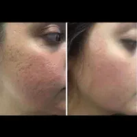 پاکسازی پوست فشیال لیزر پوست فیشیال|خدمات آرایشگری و زیبایی|شیراز, درکی|دیوار