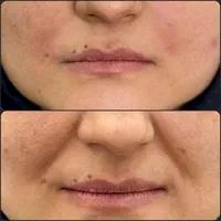 افر ویژه‌ی فیلر/بوتاکس/prpبا قیمت باورنکردنی|خدمات آرایشگری و زیبایی|تهران, دروازه شمیران|دیوار