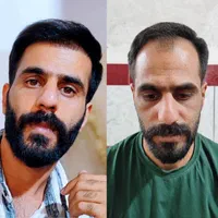 کاشت مو وابرو وریش(نقد واقساط ) اقساطی|خدمات آرایشگری و زیبایی|شیراز, بعثت|دیوار