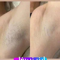جشنواره بهاری لیزر موی زائد فول ۴۲۰ به مدت محدود|خدمات آرایشگری و زیبایی|ارومیه, |دیوار