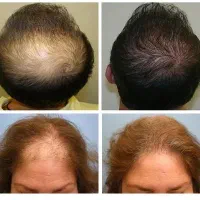 جوش و تیرگی صورت ، ریزش مو ، جوانسازی پوست|خدمات آرایشگری و زیبایی|رفسنجان, |دیوار