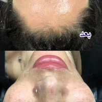 پاکسازی رایگان پوست مطهری|خدمات آرایشگری و زیبایی|رشت, خمیران زاهدان|دیوار